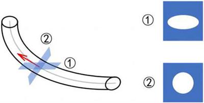 A method for detecting ureteral stent encrustations in medical CT images based on Mask-RCNN and 3D morphological analysis